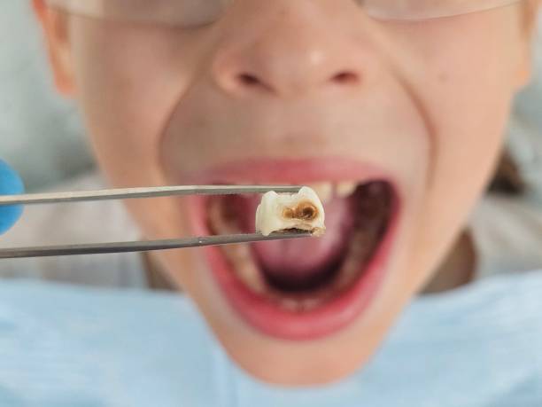 Best Dental Abscess Treatment in Moundville, AL